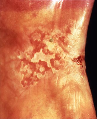 NIH DOC 19 Erythroleukoplakia