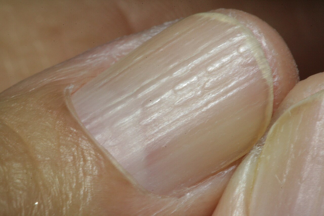 Lichen planus in finger nails