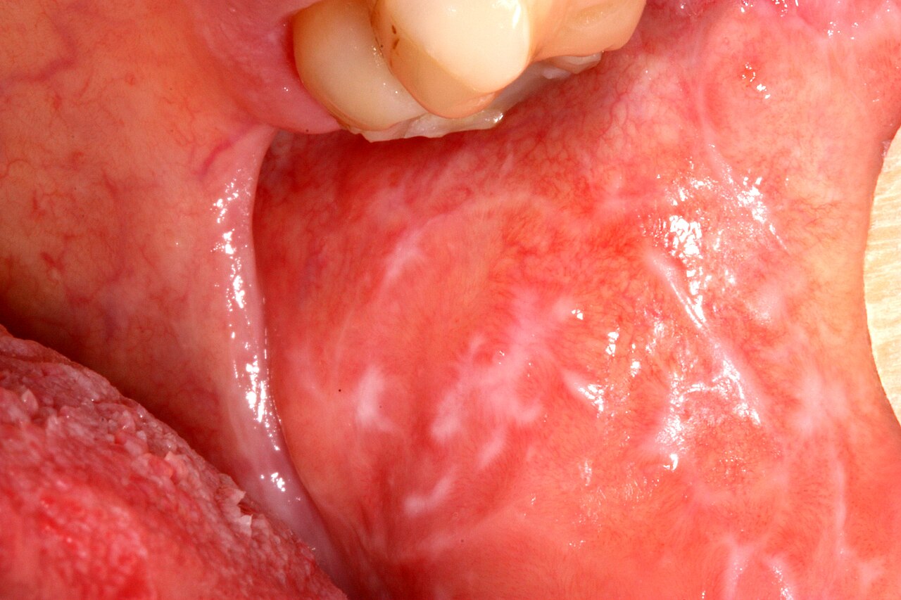 Lichen planus