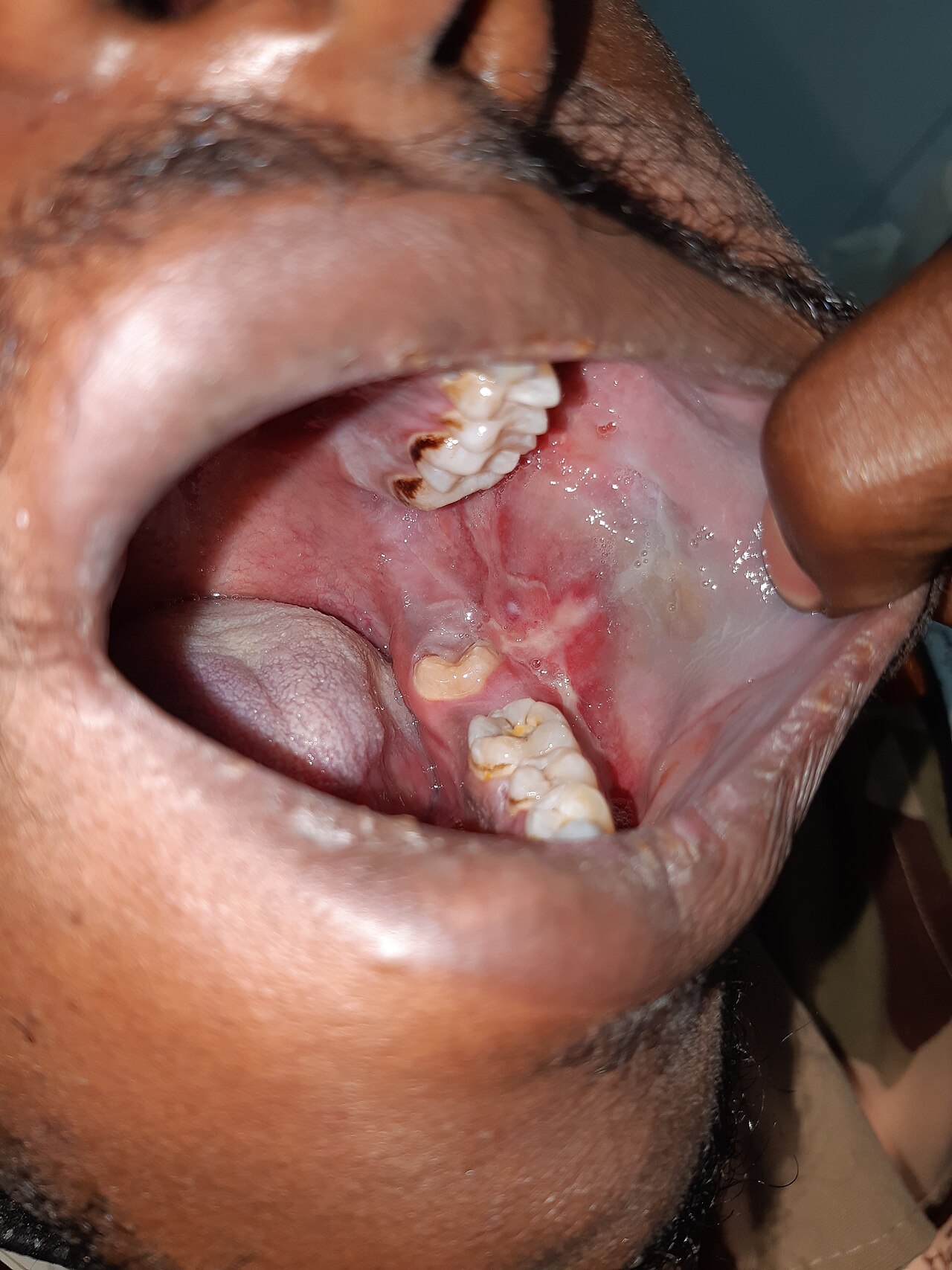 Lichen planus-intra oral lesion