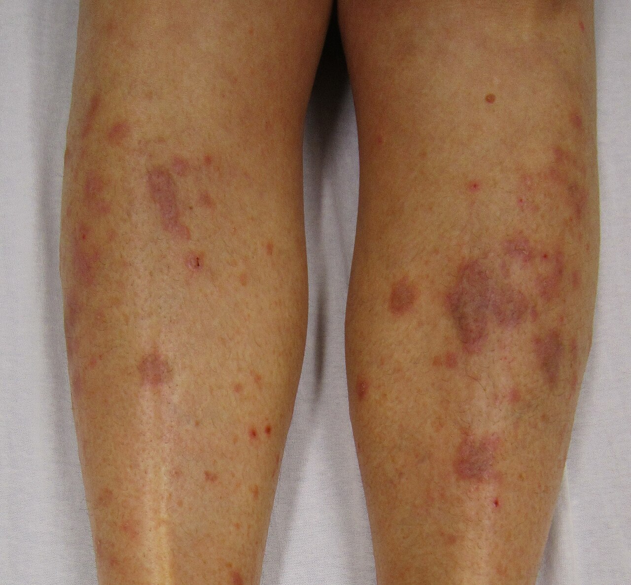 Lichen Planus (2)