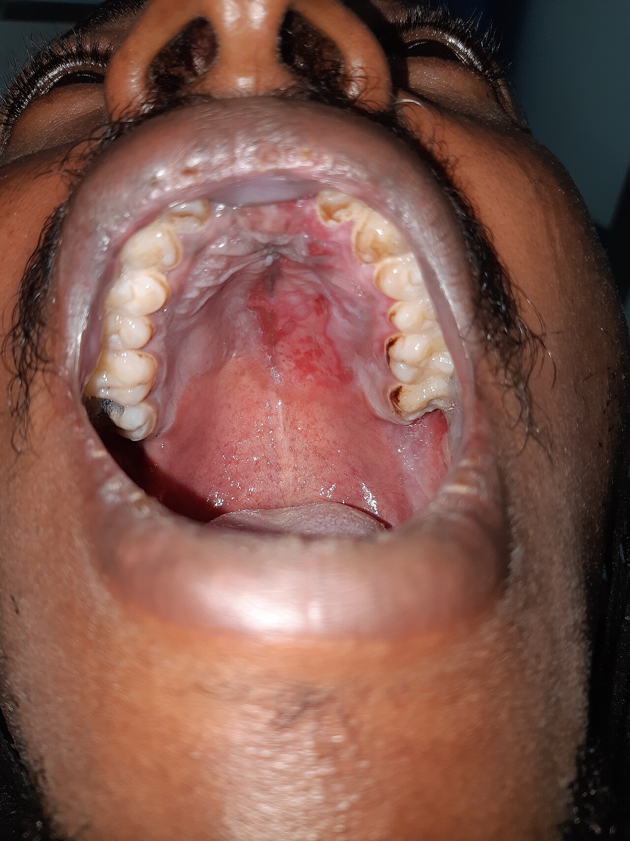Erosive lichen planus
