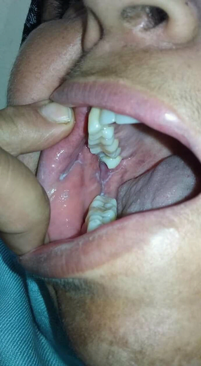 Lichen planus new image