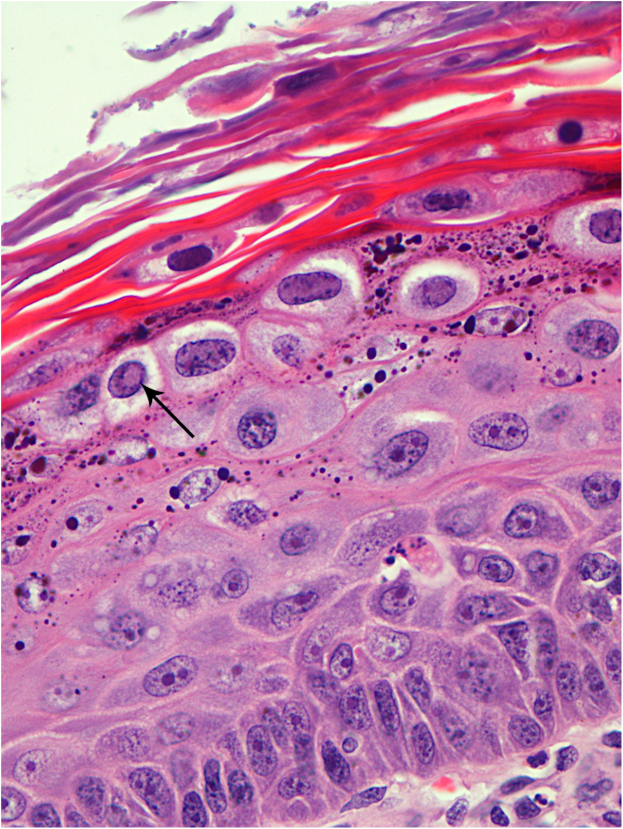 Histological characteristics of canine oral viral papilloma hyperkeratosis, hypergranulosis, koilocytes and inclusion bodies (arrow)