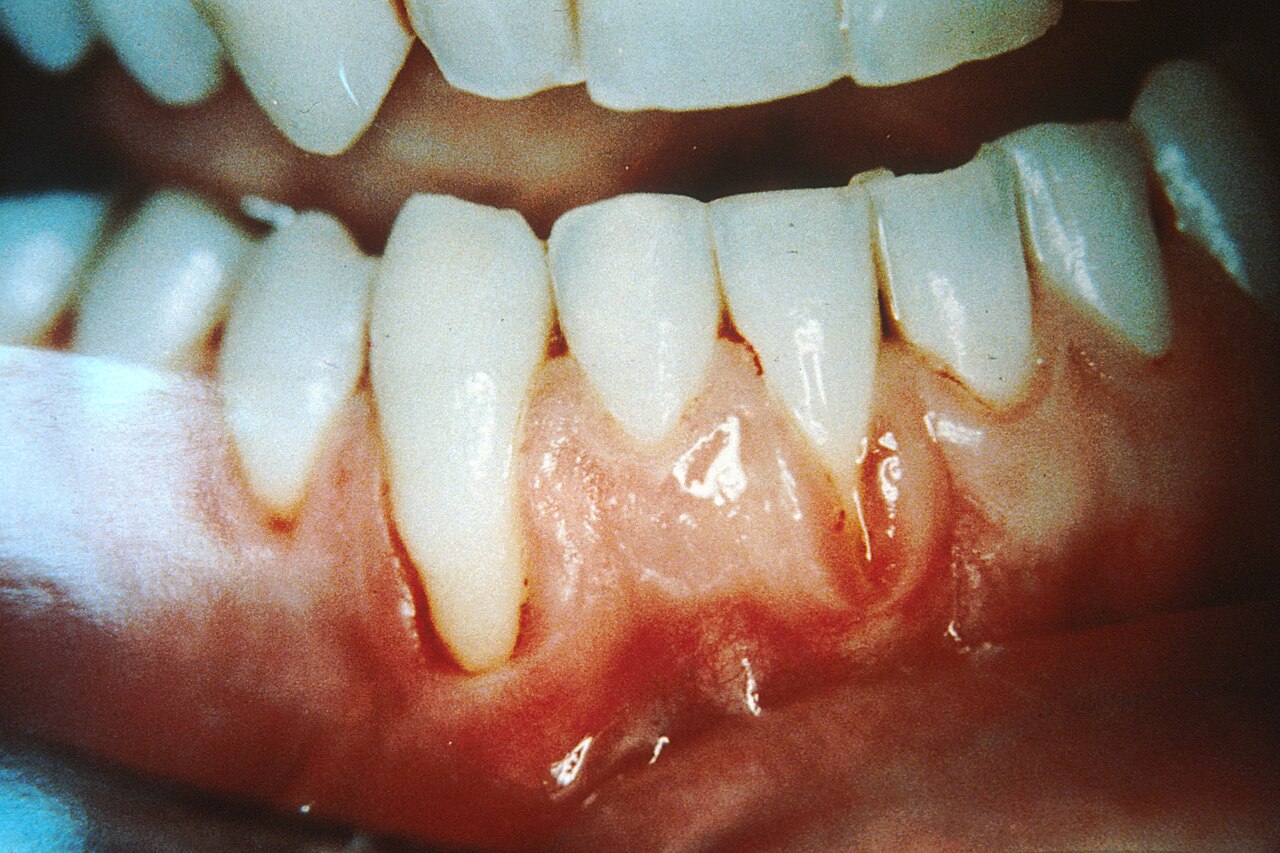 Mouth and gum damage