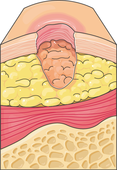 Dermatology - Ulcer 2 -- Smart-Servier