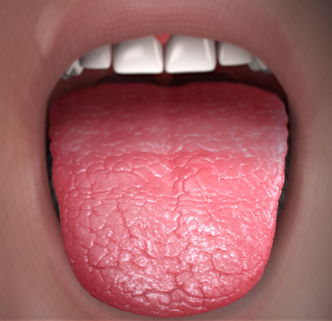 Xerostomia - Dry Mouth