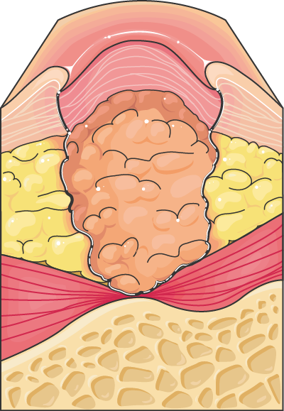 Dermatology - Ulcer 3 -- Smart-Servier