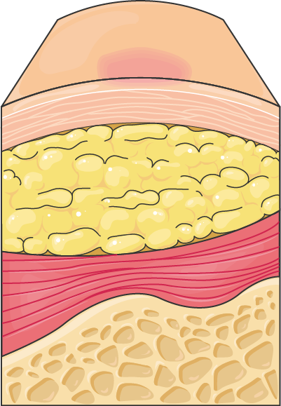 Dermatology - Ulcer 1 -- Smart-Servier