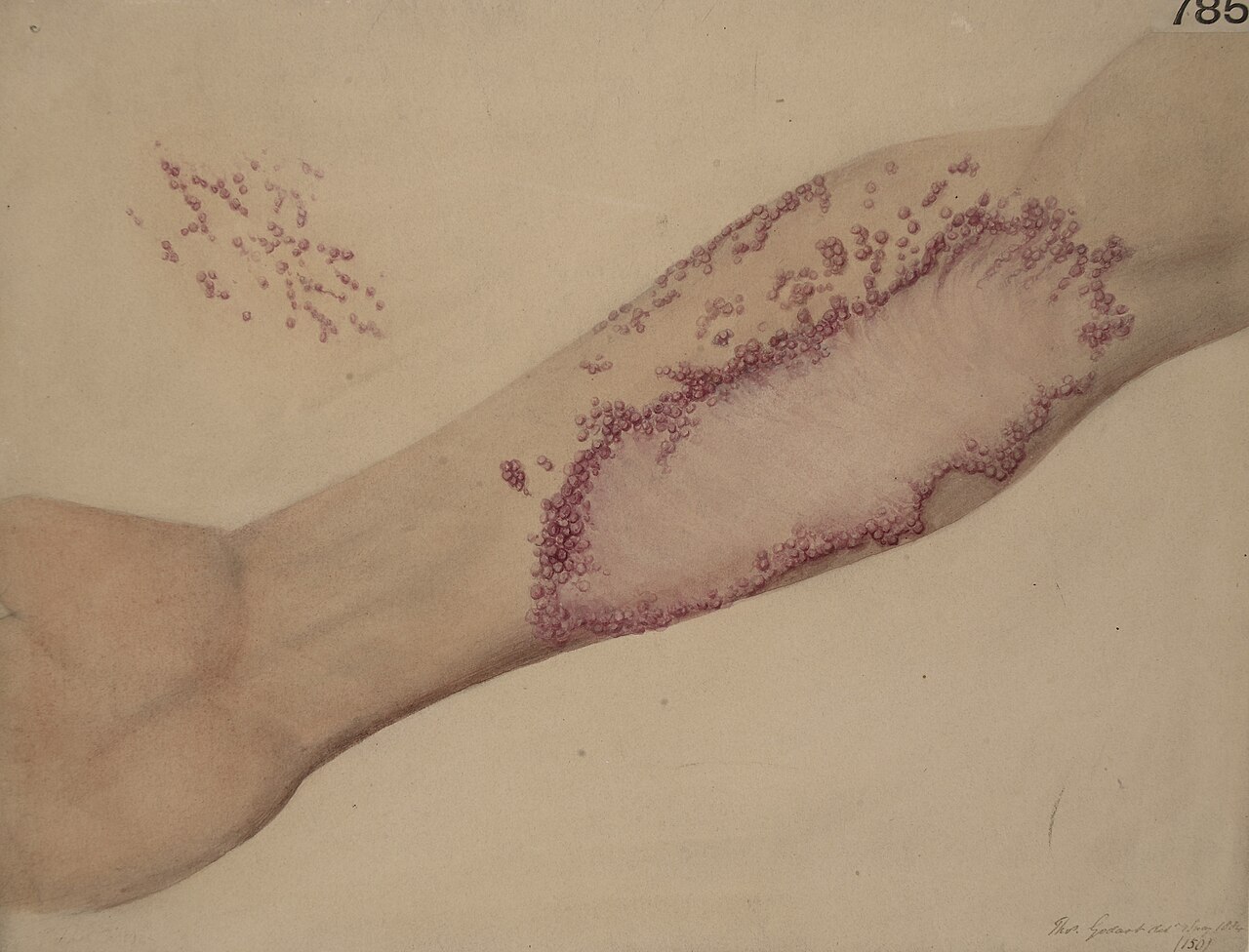 Arm of a man with an unusual form of lichen planus Wellcome L0061913