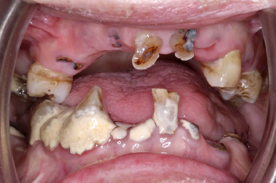 Caries, Periodontal disease, calculus