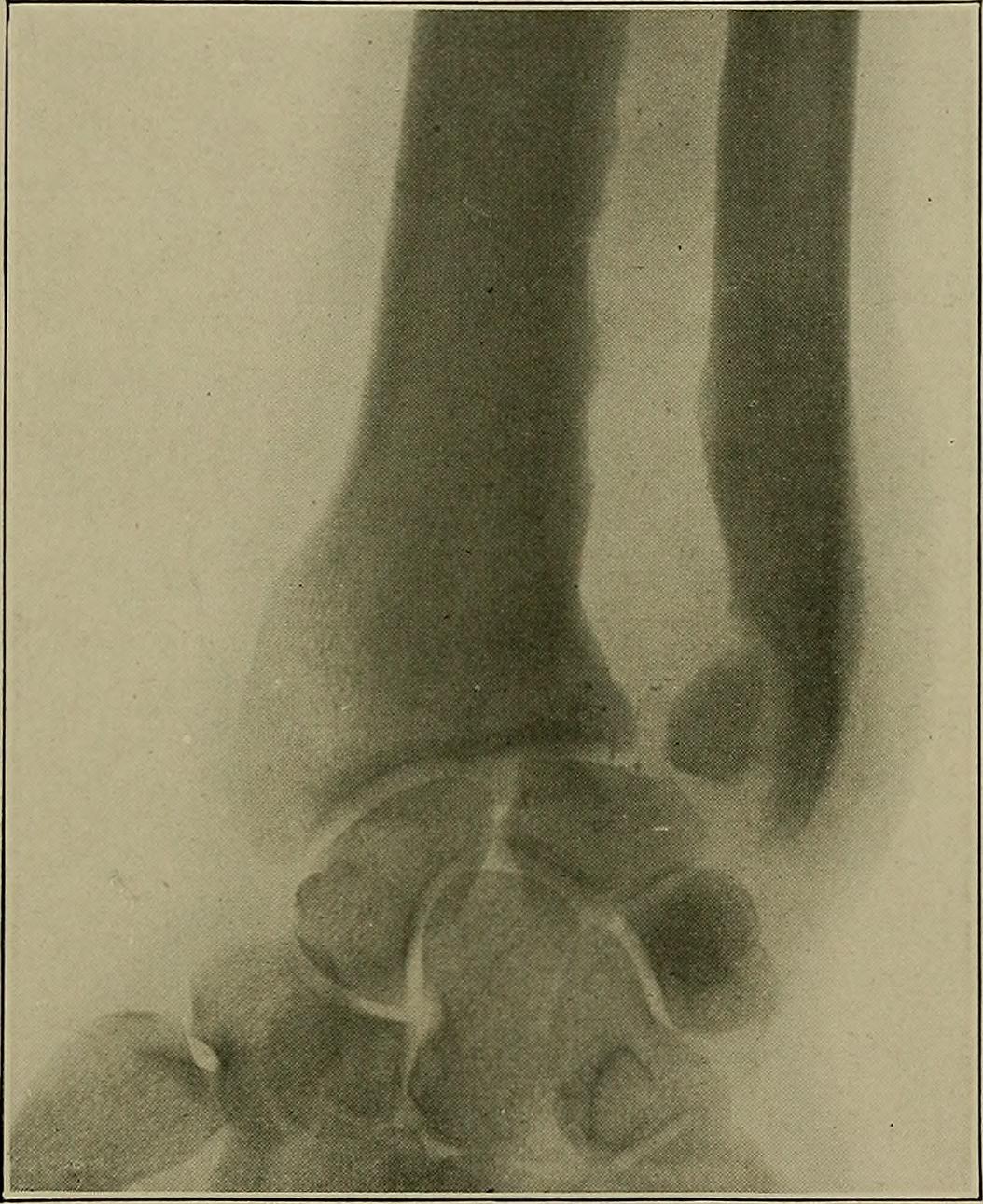Syphilis - a treatise on etiology, pathology, diagnosis, prognosis, prophylaxis, and treatment (1921) (14772663962)