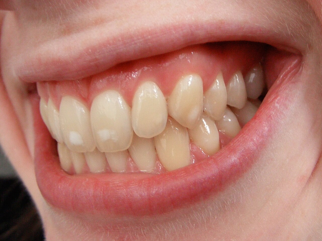 Dental fluorosis