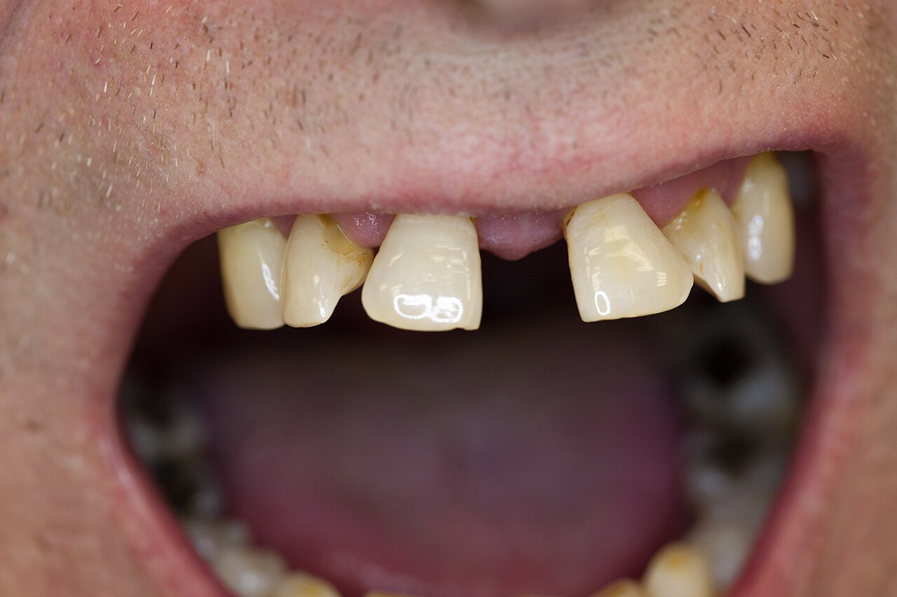 Zahnwanderung wegen Periodontitis OK 04