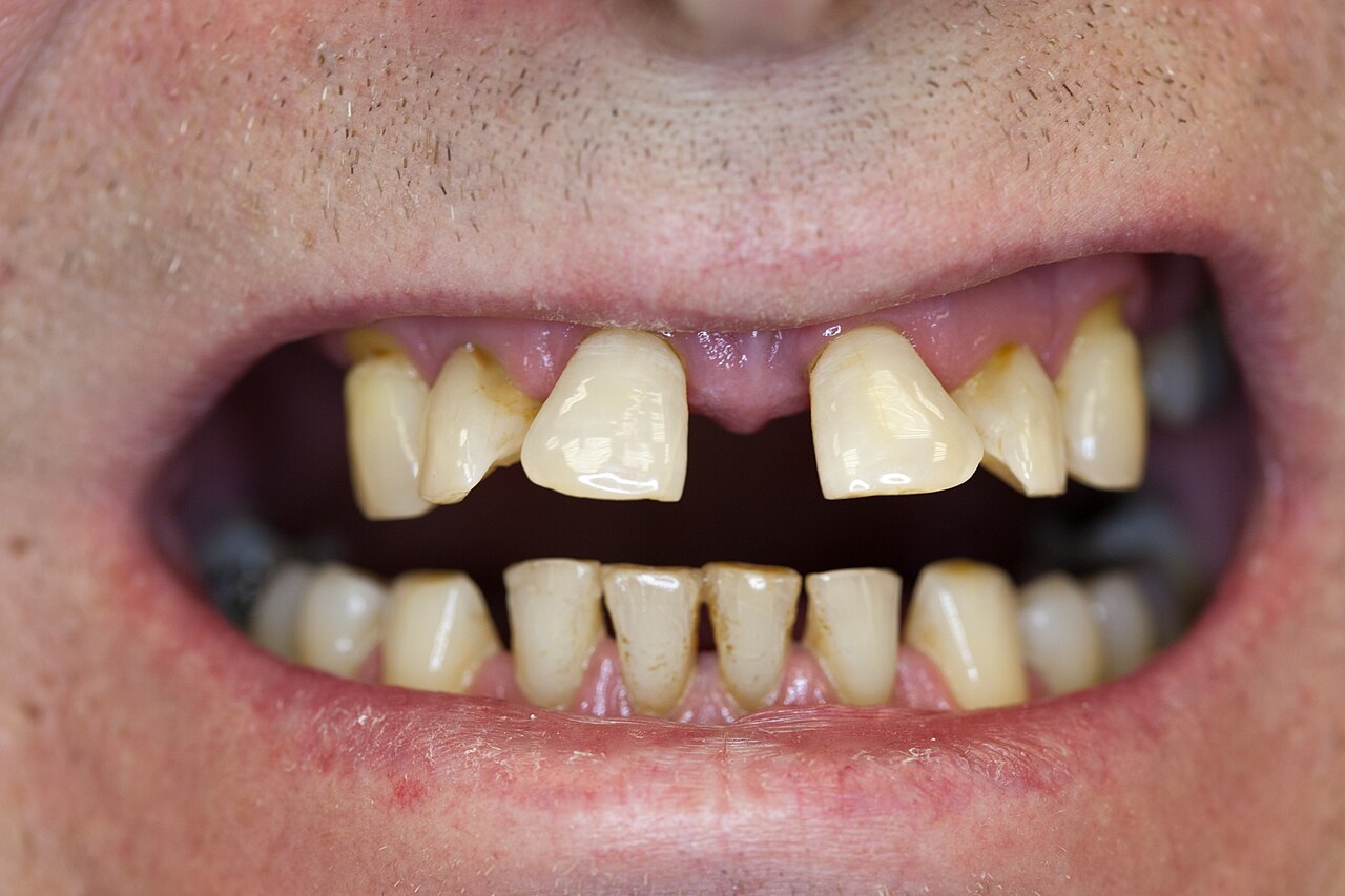 Zahnwanderung wegen Periodontitis OK 02